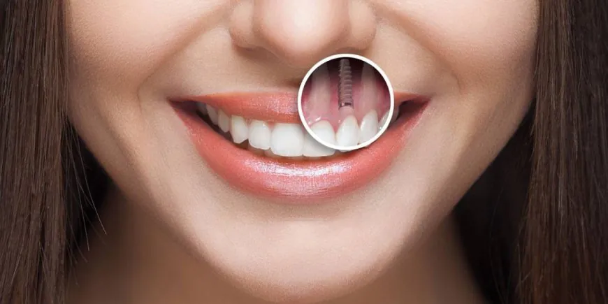 İmplant nedir? Uygulama süreci, sonrası ve avantajları